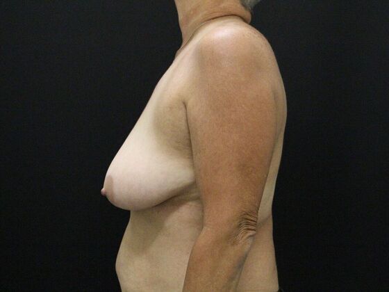 Breast Reduction & Lift: Case 28 - Before