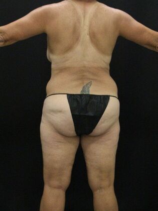 Tummy Tuck: Case 60 - Before