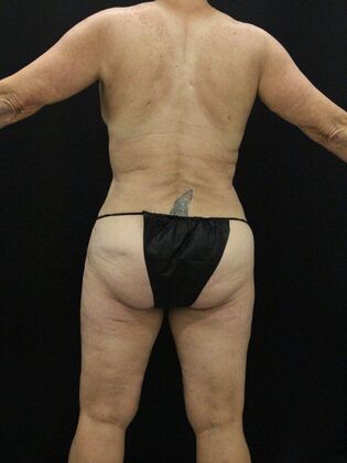 Tummy Tuck: Case 60 - After