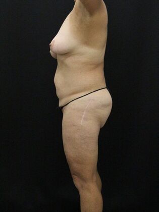 Tummy Tuck: Case 60 - Before