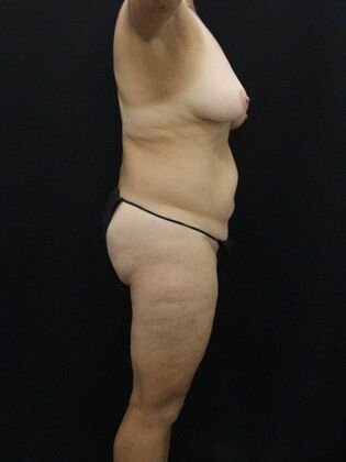 Tummy Tuck: Case 60 - Before