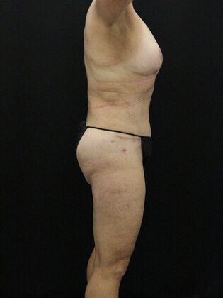 Tummy Tuck: Case 60 - After