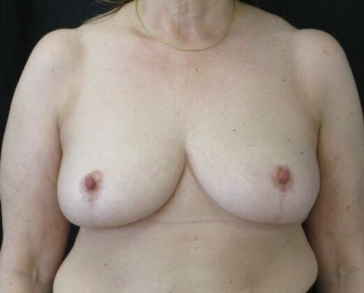 Breast Reduction Case 14 - After