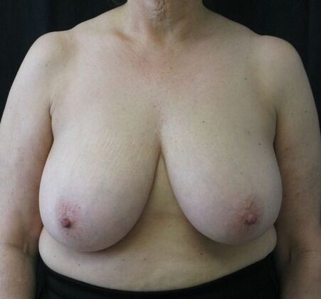 Breast Reduction Case 14 - Before