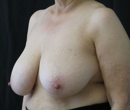Breast Reduction: Case 14 - Before