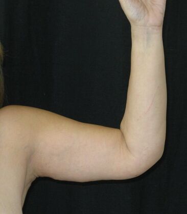 Brachioplasty (Arm Lift): Case 5 - After