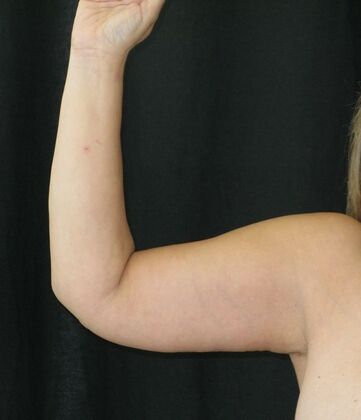 Brachioplasty (Arm Lift) Case 5 - After