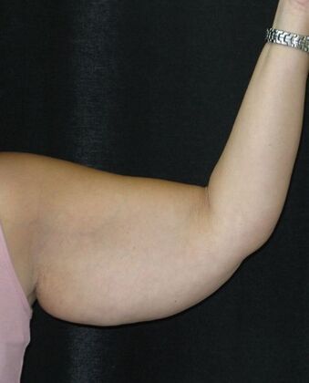 Brachioplasty (Arm Lift): Case 5 - Before