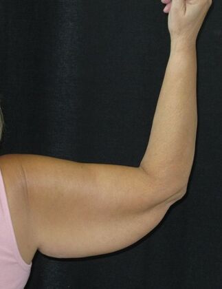 Brachioplasty (Arm Lift): Case 5 - Before