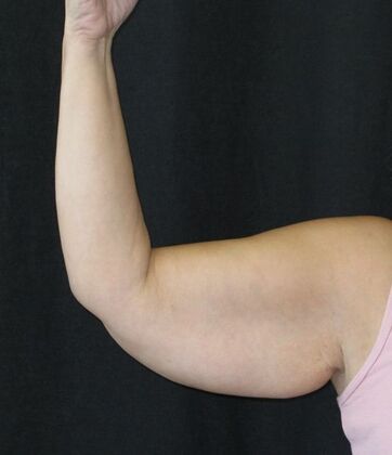 Brachioplasty (Arm Lift) Case 5 - Before