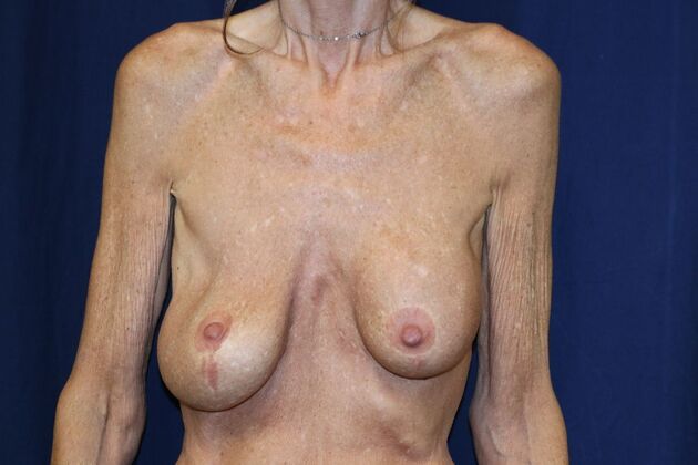 Breast Implant Removal and Exchange Case 17 - Before