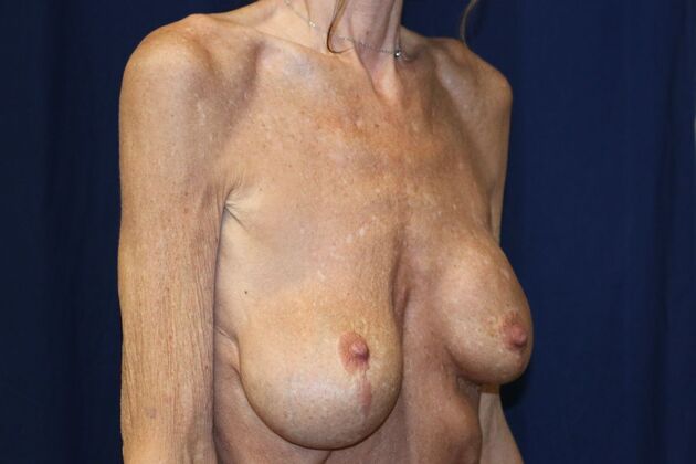 Breast Implant Removal and Exchange: Case 17 - Before