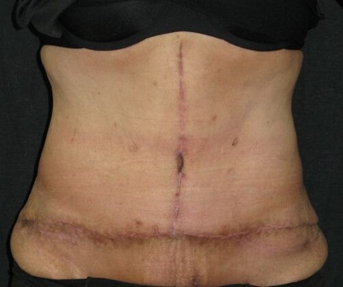Abdominoplasty Case 12 - After