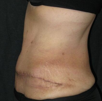 Abdominoplasty: Case 12 - After
