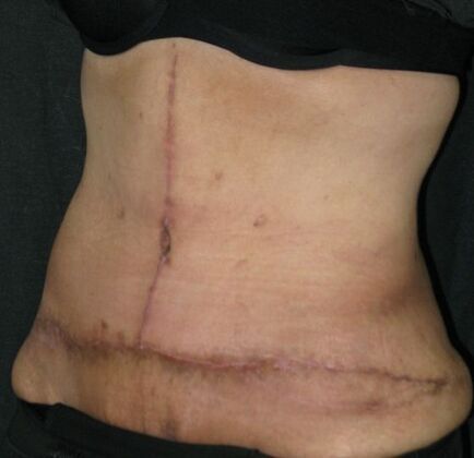 Abdominoplasty: Case 12 - After