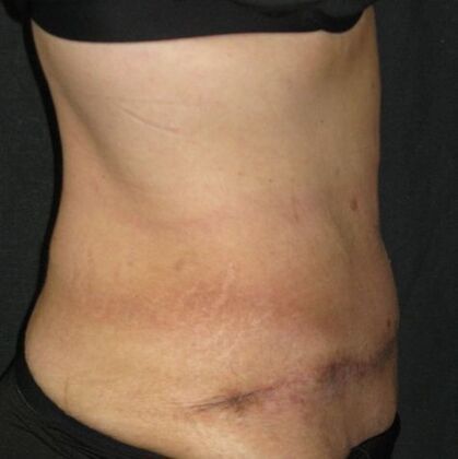 Abdominoplasty: Case 12 - After
