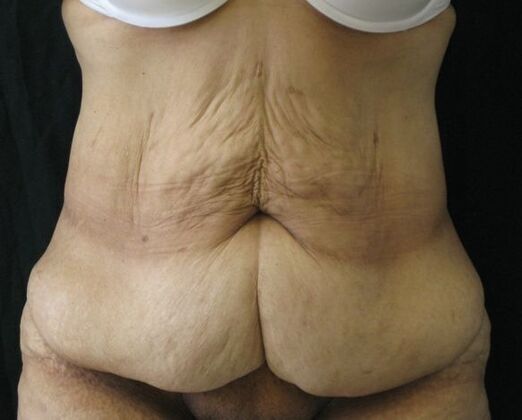 Abdominoplasty Case 12 - Before