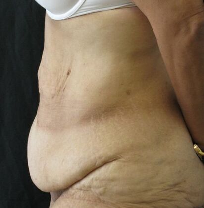 Abdominoplasty: Case 12 - Before