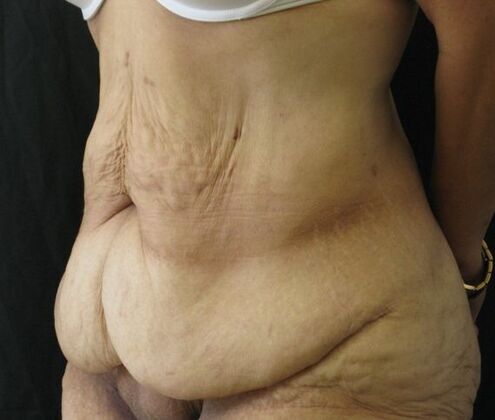 Abdominoplasty: Case 12 - Before