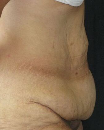 Abdominoplasty: Case 12 - After