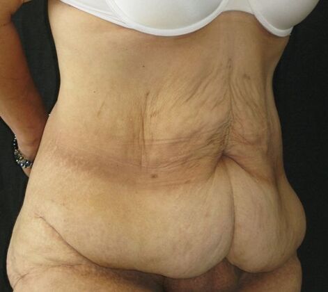 Abdominoplasty: Case 12 - Before