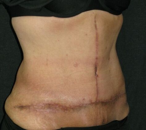 Abdominoplasty: Case 12 - After