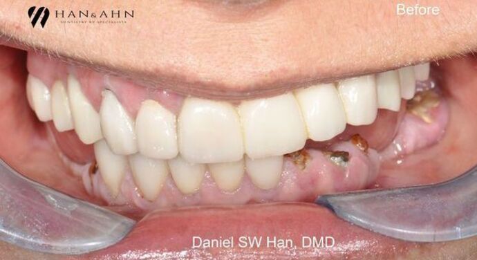 Full Mouth Reconstruction: Case 3: Teeth in One Day - Initial (before the reconstruction)