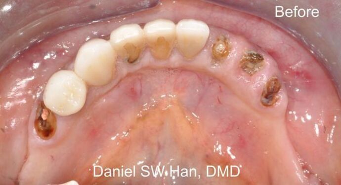 Full Mouth Reconstruction: Case 3: Teeth in One Day - Initial visit (before the reconstruction)