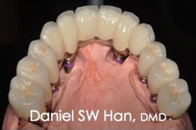 Full Mouth Reconstruction: Case 2 - After