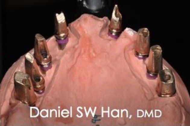 Full Mouth Reconstruction: Case 2 - Before