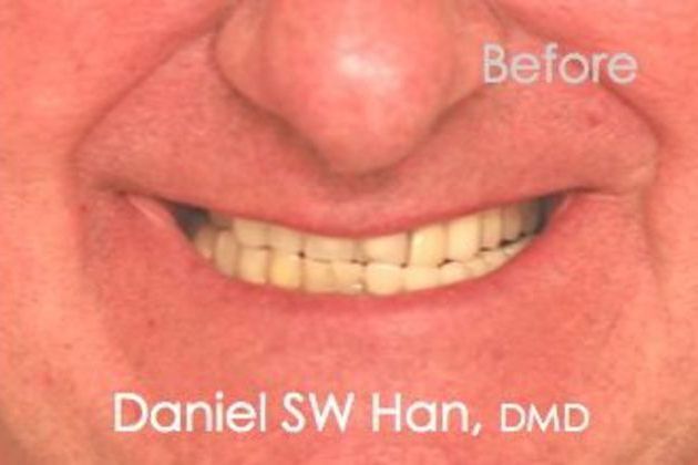 Full Mouth Reconstruction: Case 2 - Before