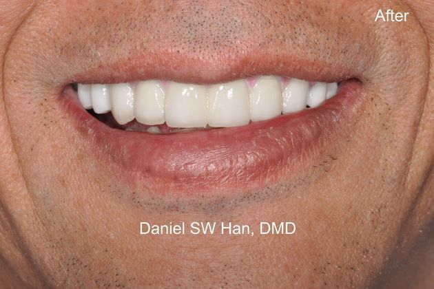 Full Mouth Reconstruction: Case 5 - Smile after full mouth reconstruction