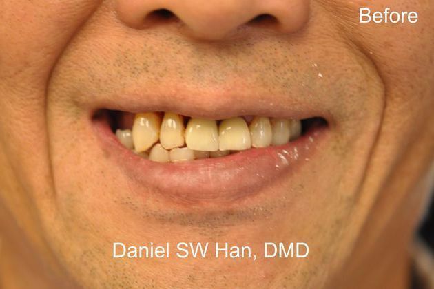 Full Mouth Reconstruction: Case 5 - Smile before the full mouth reconstruction