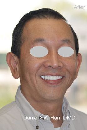 Full Mouth Reconstruction: Case 5 - Maxillary Reconstruction with Implant Supported Fixed Hybrid