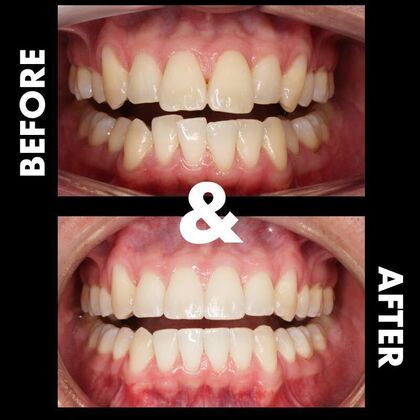 Orthodontics  Alex -  Braces - Before