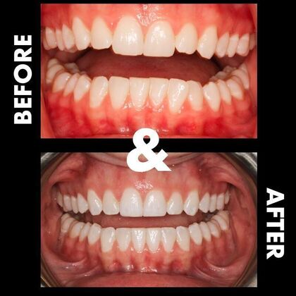 Orthodontics  Cassie - Invisalign - Before