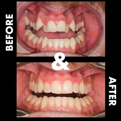 Orthodontics : Caleb  - Invisalign - Before