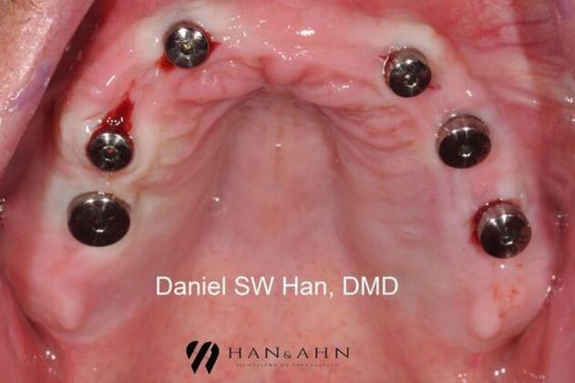 Full Mouth Reconstruction: Case 6 - Implant surgery