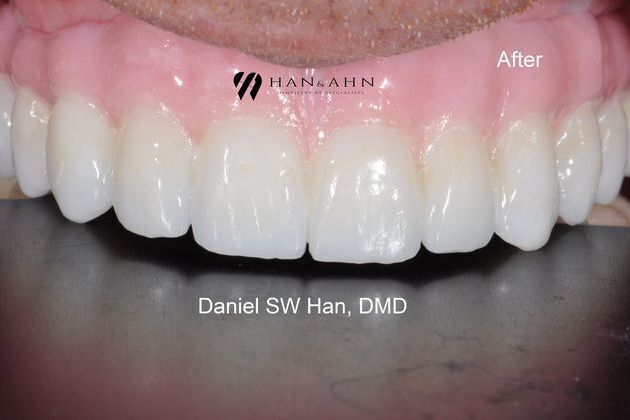 Full Mouth Reconstruction: Case 6 - Final Fixed Hybrid Prosthesis (fixed denture)