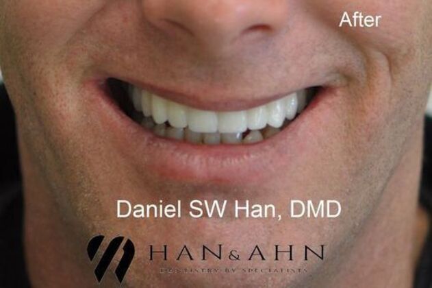 Full Mouth Reconstruction: Case 6 - After