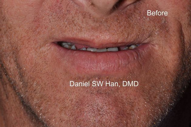 Full Mouth Reconstruction: Case 6 - Before