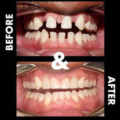 Orthodontics  Darius - Braces  - Before