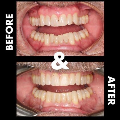 Orthodontics  Dave - Invisalign - Before