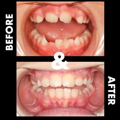 Orthodontics  Hank - Braces - Phase 1 Complete   - Before
