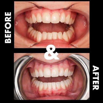 Orthodontics  Emma-Beth - Invisalign - Before