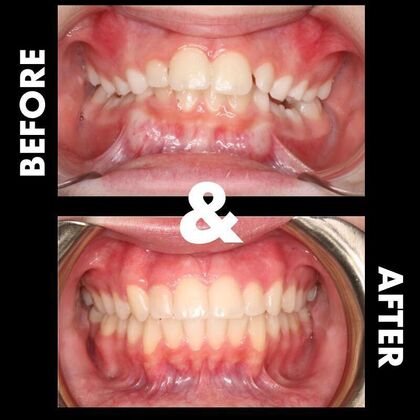 Orthodontics  Lucy - Braces - Phase 1 & 2  - Before