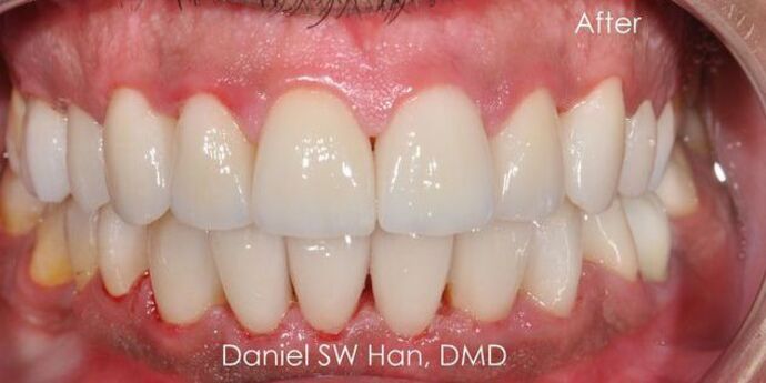 Full Mouth Reconstruction: Case 7: Before the wedding Cosmetic Makeover - After