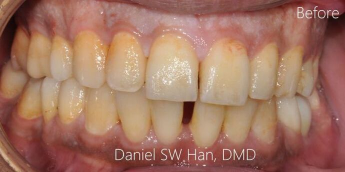 Full Mouth Reconstruction: Case 7: Before the wedding Cosmetic Makeover - Before