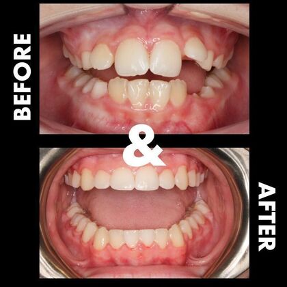 Orthodontics  Nate - Braces - Phase 1 & 2 - Before