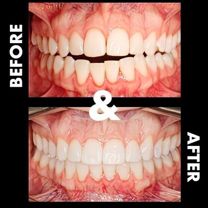 Orthodontics  Natasha - Invisalign - Before